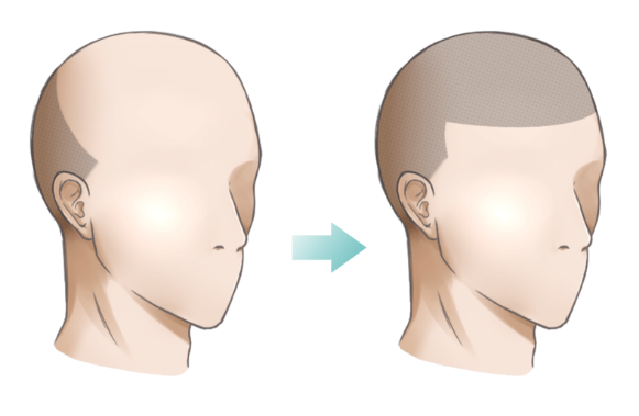 発毛しない頭皮
